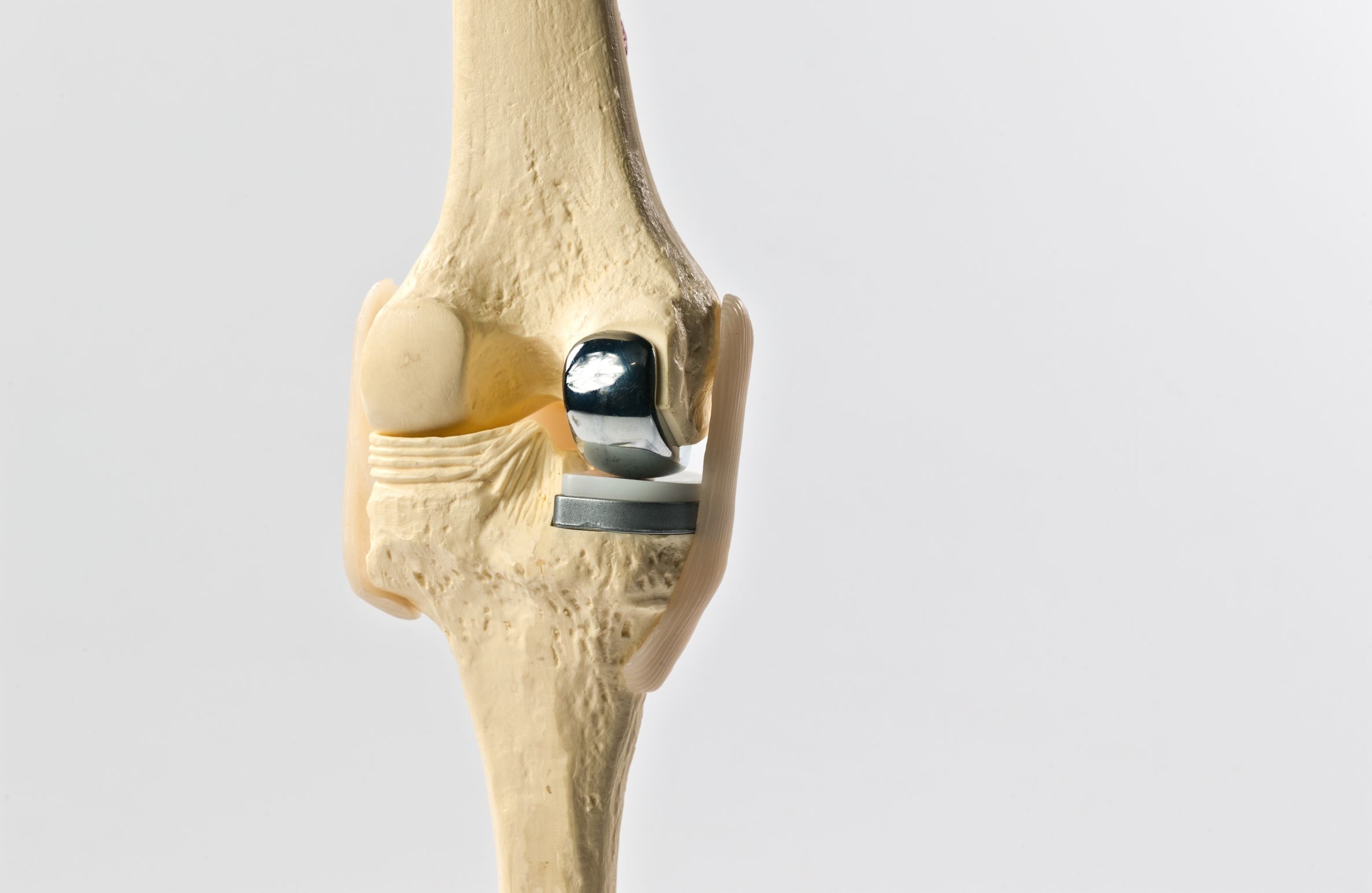 partial-knee-arthroplasty-dr-michael-serhal